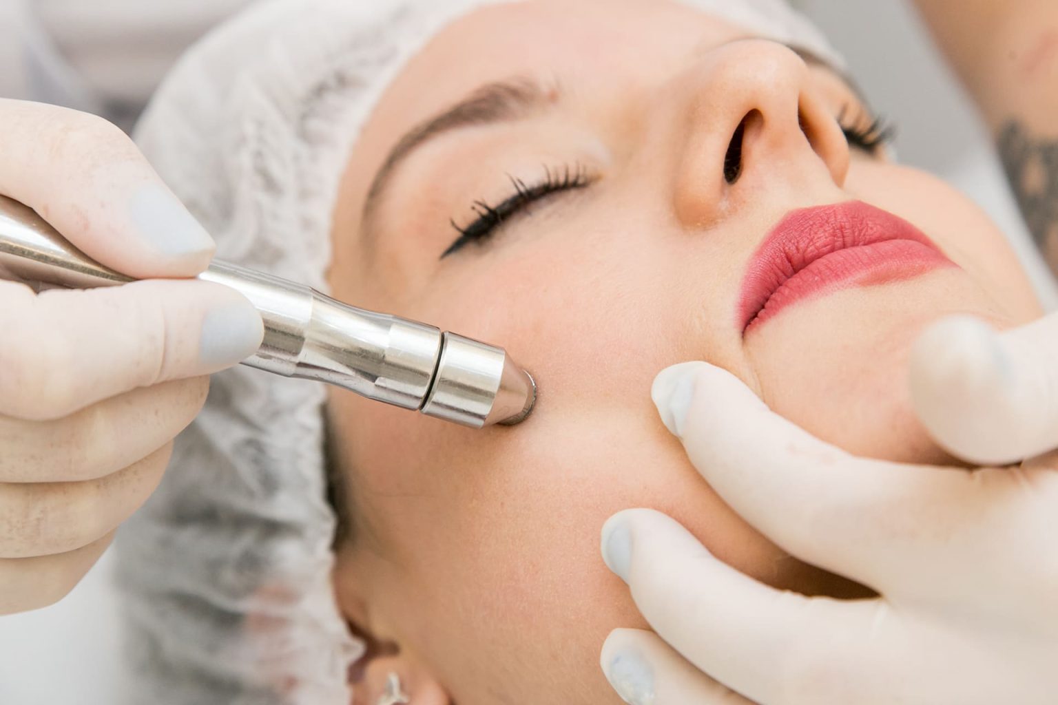 Peeling Diamante - Estética Facial - Chez Elle Estética e Laser - Campinas